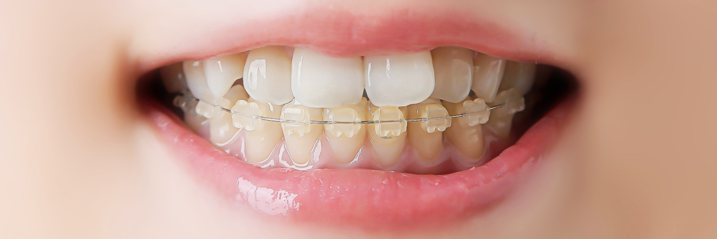 矯正装置 – かなやまクリニック