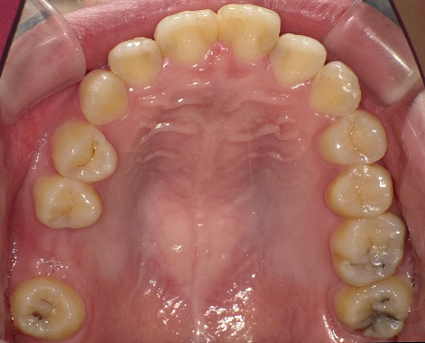 症例集 - 歯科ミントクリニック（富山県滑川市）